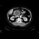 Cystoid of pancreas: CT - Computed tomography